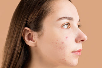 How to Get Rid of Acne Scars Once and For All