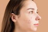 How to Get Rid of Acne Scars Once and For All